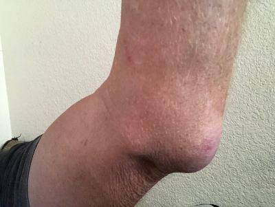 1 Elbow 2.jpg