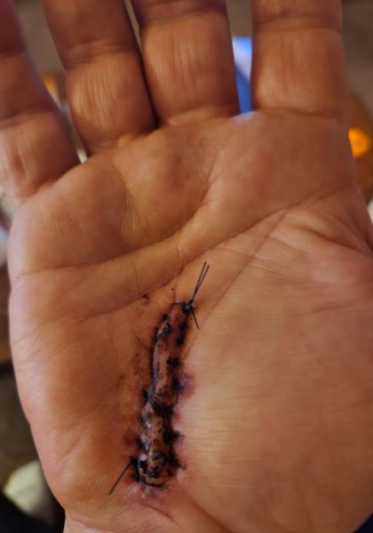 CTS Surgery .jpg