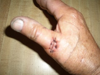 My thumb 3 001 (Phone).JPG