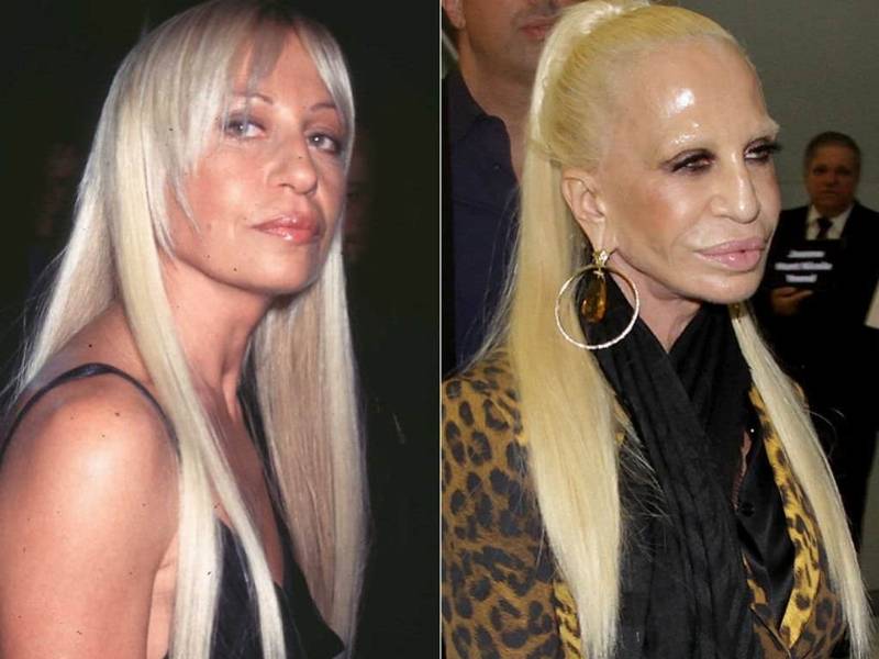 st-cases-of-celebrity-plastic-surgery-gone-wrong-1.jpg