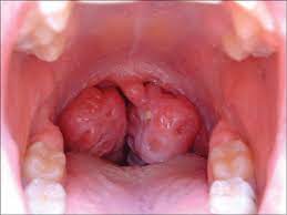 tonsils.jpeg tonsils.jpeg