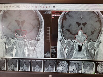 tumors.jpg tumors.jpg