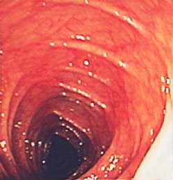 natural-colon-cancer-healthy-colon.jpg