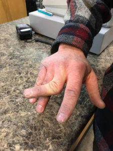 Bent finger.jpg